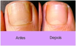 Podologia Tratamento da unha infeccionada