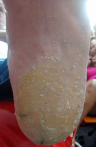 Calosidadee Fissuras nos Pés