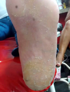 Tratamento da Calosidade e Fissuras nos Pés