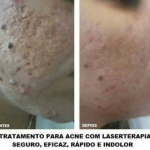 Tratamento Para Acne